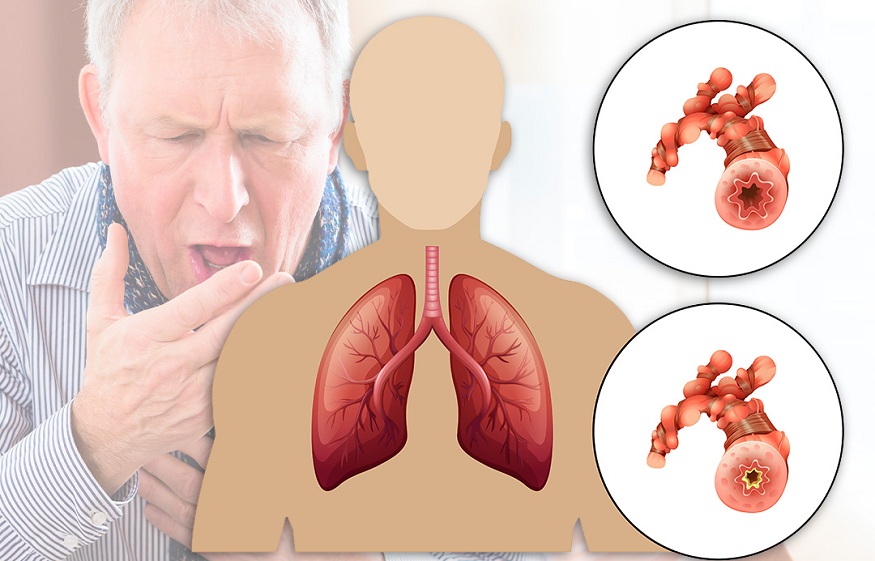 Obstructive Pulmonary Disease, Its Symptoms And Causes?